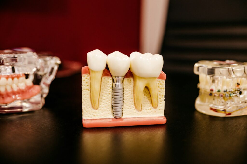 A dental implant model positioned between two natural teeth in a section of gums and bone.